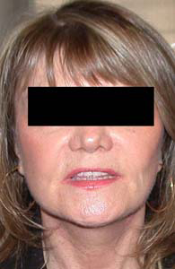 chirurgie-esthetique-interventions-visage-liftings-015