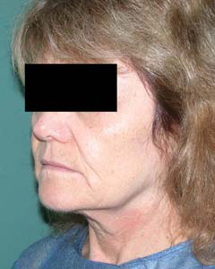 chirurgie-esthetique-interventions-visage-liftings-016