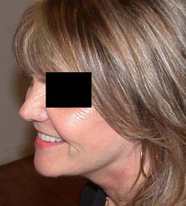 chirurgie-esthetique-interventions-visage-liftings-017