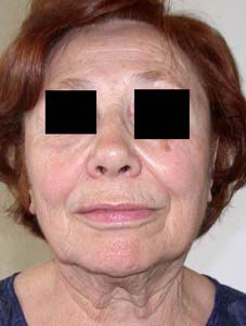 chirurgie-esthetique-interventions-visage-liftings-018