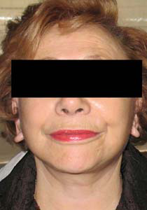 chirurgie-esthetique-interventions-visage-liftings-019