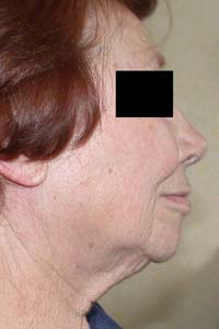 chirurgie-esthetique-interventions-visage-liftings-020