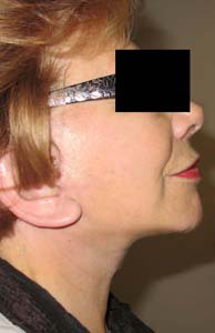 chirurgie-esthetique-interventions-visage-liftings-021