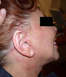 chirurgie-esthetique-interventions-visage-liftings-023