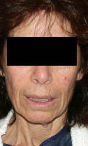 chirurgie-esthetique-interventions-visage-liftings-024