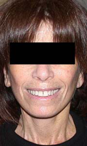 chirurgie-esthetique-interventions-visage-liftings-025