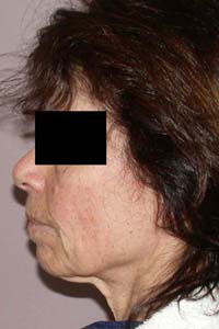 chirurgie-esthetique-interventions-visage-liftings-026