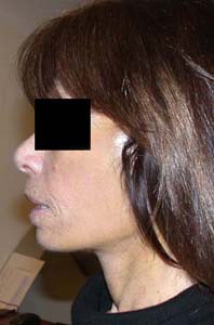 chirurgie-esthetique-interventions-visage-liftings-027