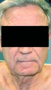 chirurgie-esthetique-interventions-visage-liftings-028