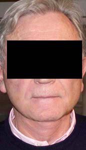 chirurgie-esthetique-interventions-visage-liftings-029