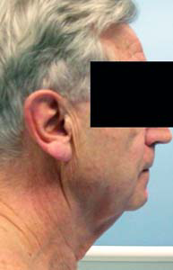 chirurgie-esthetique-interventions-visage-liftings-030