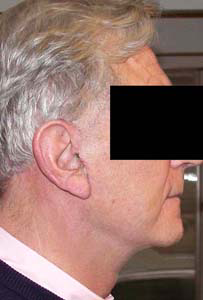 chirurgie-esthetique-interventions-visage-liftings-031