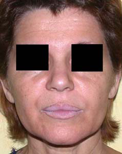 chirurgie-esthetique-interventions-visage-liftings-032