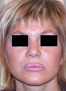 chirurgie-esthetique-interventions-visage-liftings-033