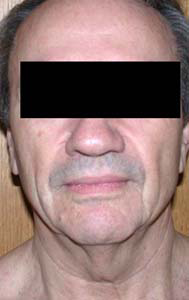 chirurgie-esthetique-interventions-visage-liftings-034