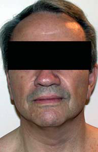 chirurgie-esthetique-interventions-visage-liftings-035