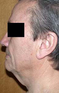 chirurgie-esthetique-interventions-visage-liftings-036