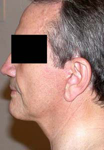 chirurgie-esthetique-interventions-visage-liftings-037