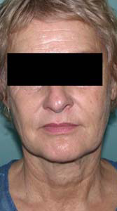 chirurgie-esthetique-interventions-visage-liftings-038