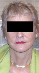 chirurgie-esthetique-interventions-visage-liftings-039