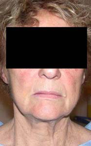 chirurgie-esthetique-interventions-visage-liftings-040