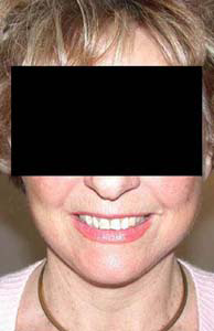 chirurgie-esthetique-interventions-visage-liftings-041