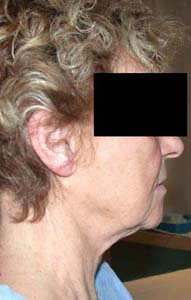 chirurgie-esthetique-interventions-visage-liftings-042