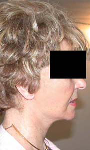 chirurgie-esthetique-interventions-visage-liftings-043