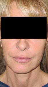 chirurgie-esthetique-interventions-visage-liftings-044