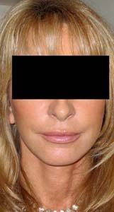 chirurgie-esthetique-interventions-visage-liftings-045