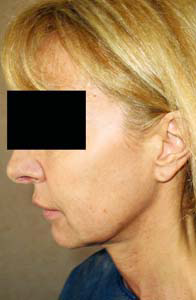 chirurgie-esthetique-interventions-visage-liftings-046