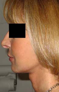 chirurgie-esthetique-interventions-visage-liftings-047
