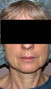 chirurgie-esthetique-interventions-visage-liftings-048