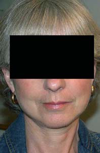 chirurgie-esthetique-interventions-visage-liftings-049