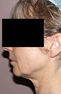 chirurgie-esthetique-interventions-visage-liftings-050