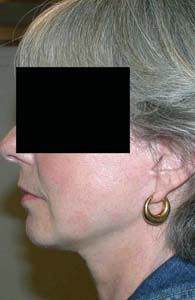 chirurgie-esthetique-interventions-visage-liftings-051