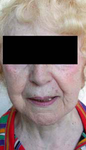 chirurgie-esthetique-interventions-visage-liftings-052