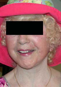 chirurgie-esthetique-interventions-visage-liftings-053