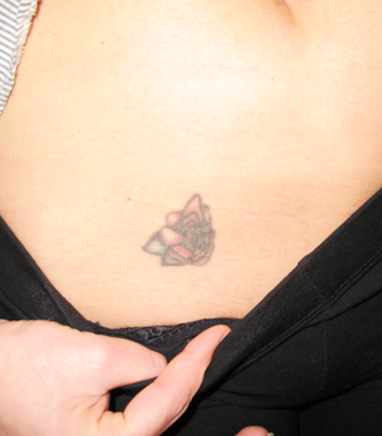 chirurgie-esthetique-tatouages