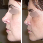 resultat_rhinoplastie_secondaire11-150x150