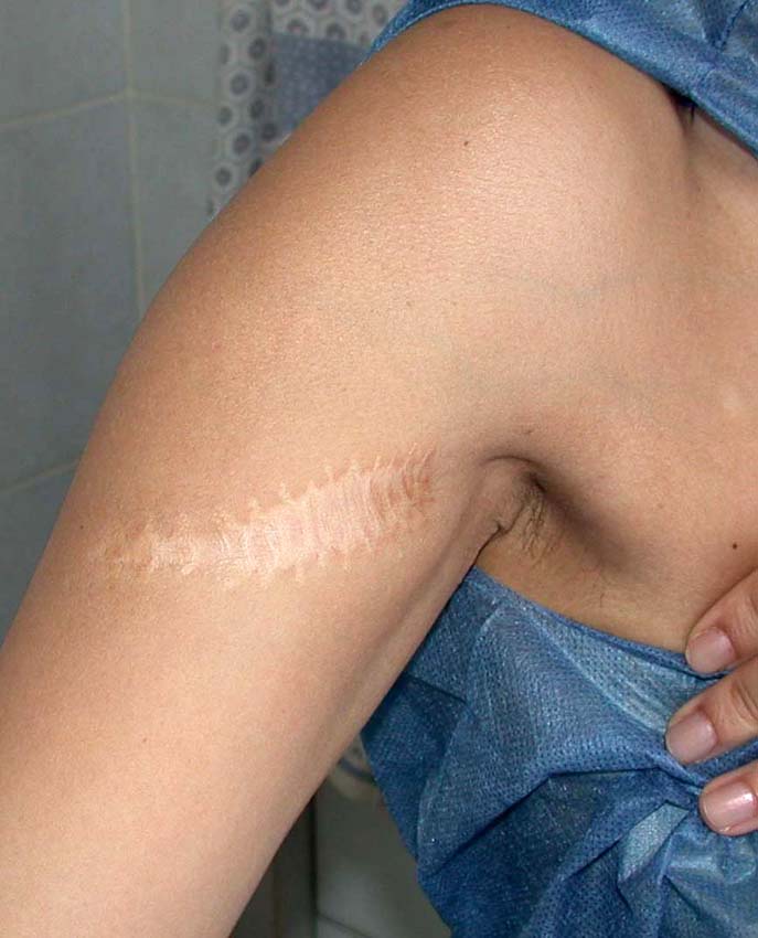 chirurgie-esthetique-cicatrices-grains-beauté00