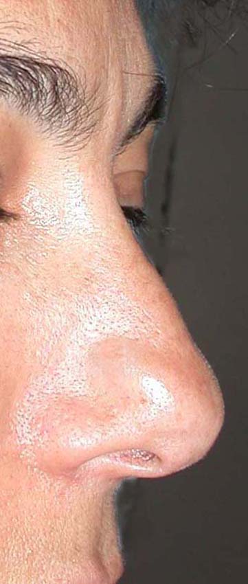 chirurgie-esthetique-cicatrices-grains-beauté03