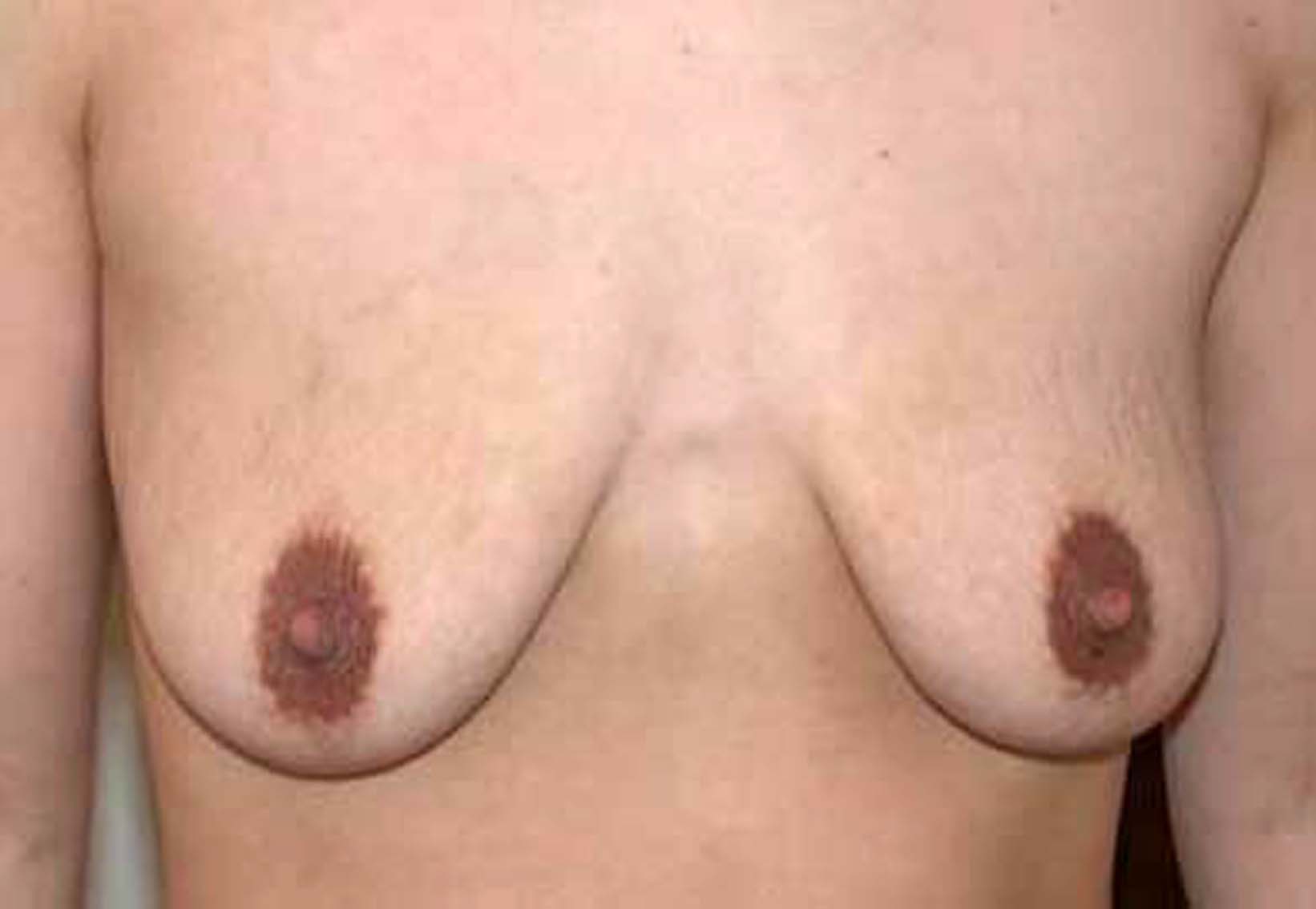 chirurgie-esthétique-correction-ptose-avec-implants03