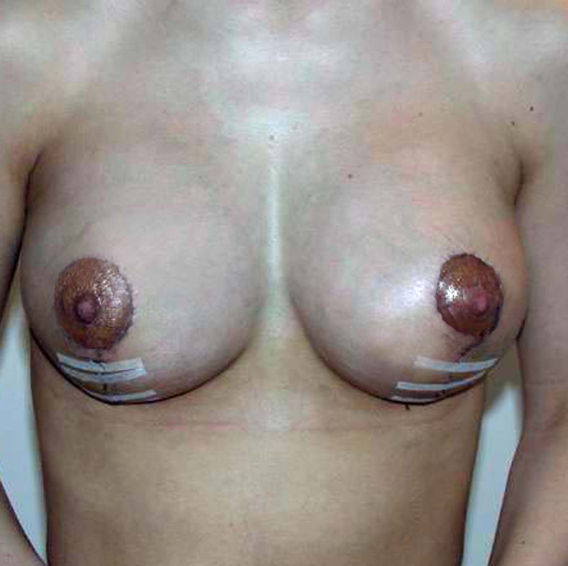 chirurgie-esthétique-correction-ptose-avec-implants04