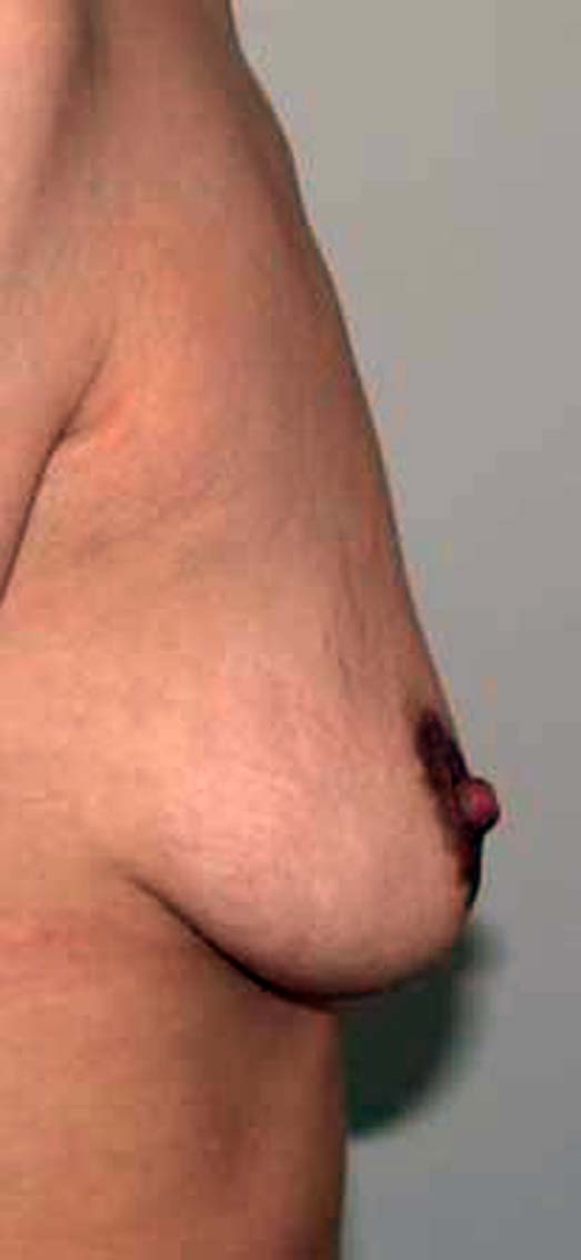 chirurgie-esthétique-correction-ptose-avec-implants05