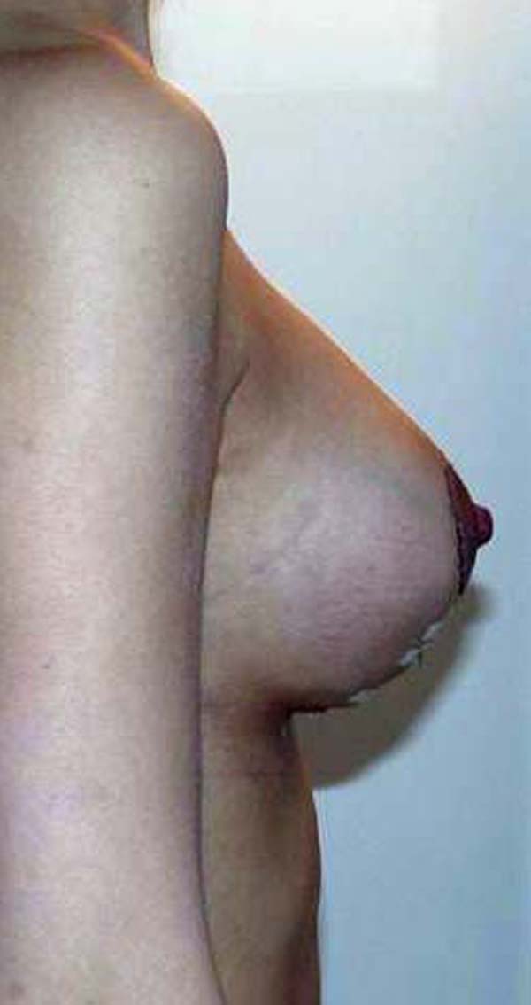 chirurgie-esthétique-correction-ptose-avec-implants06