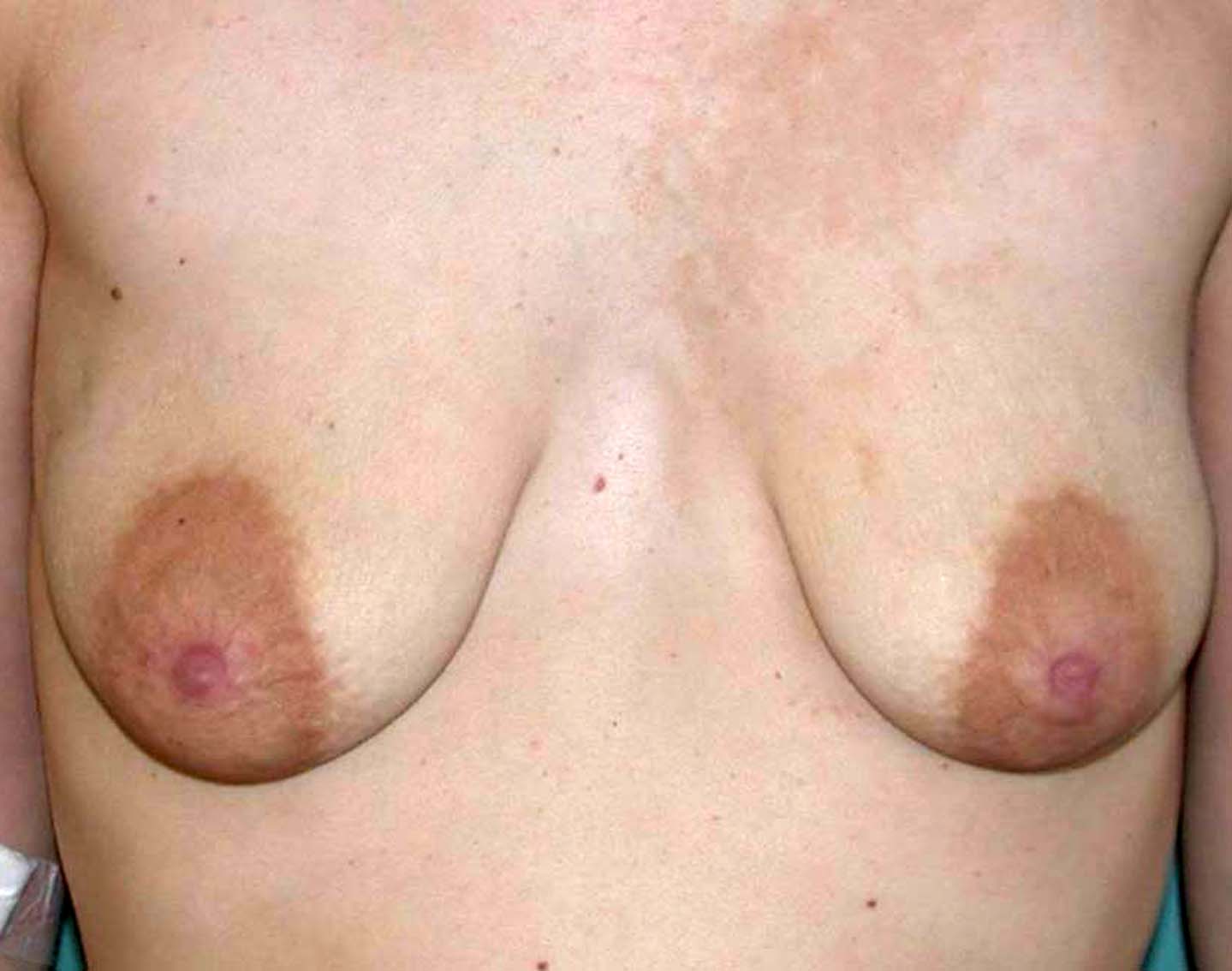 chirurgie-esthétique-correction-ptose-avec-implants08