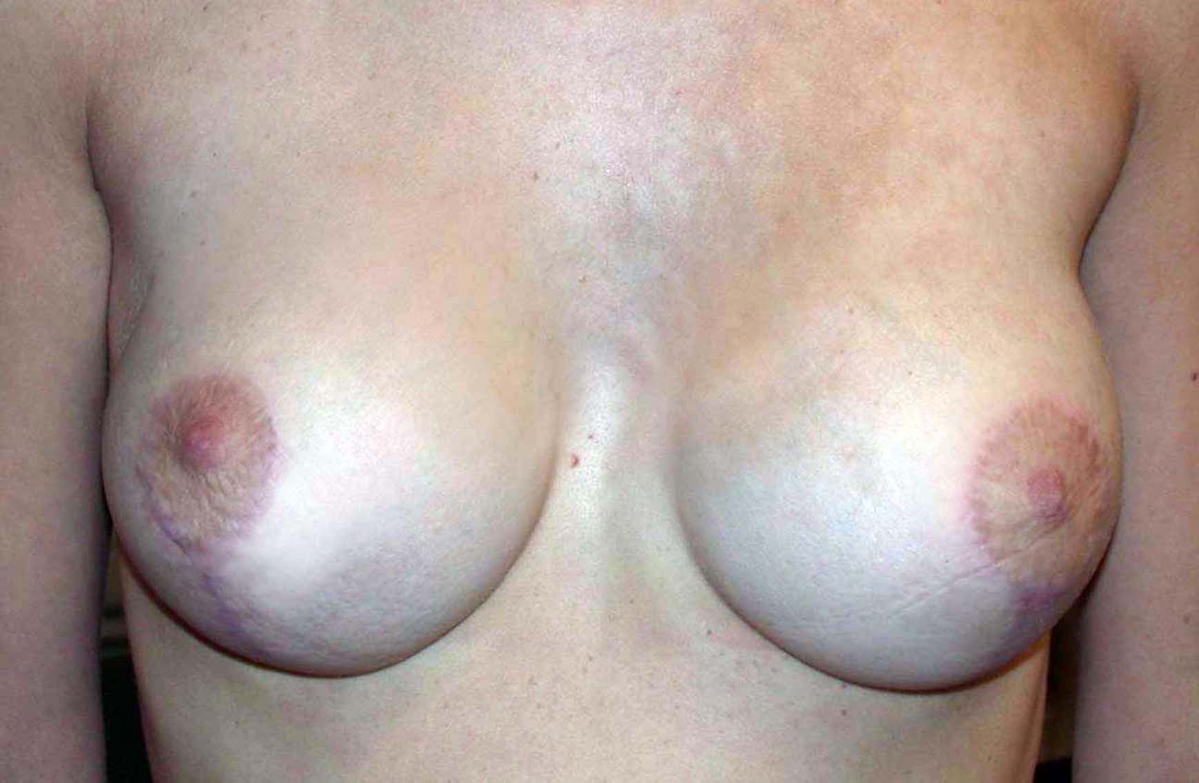 chirurgie-esthétique-correction-ptose-avec-implants09