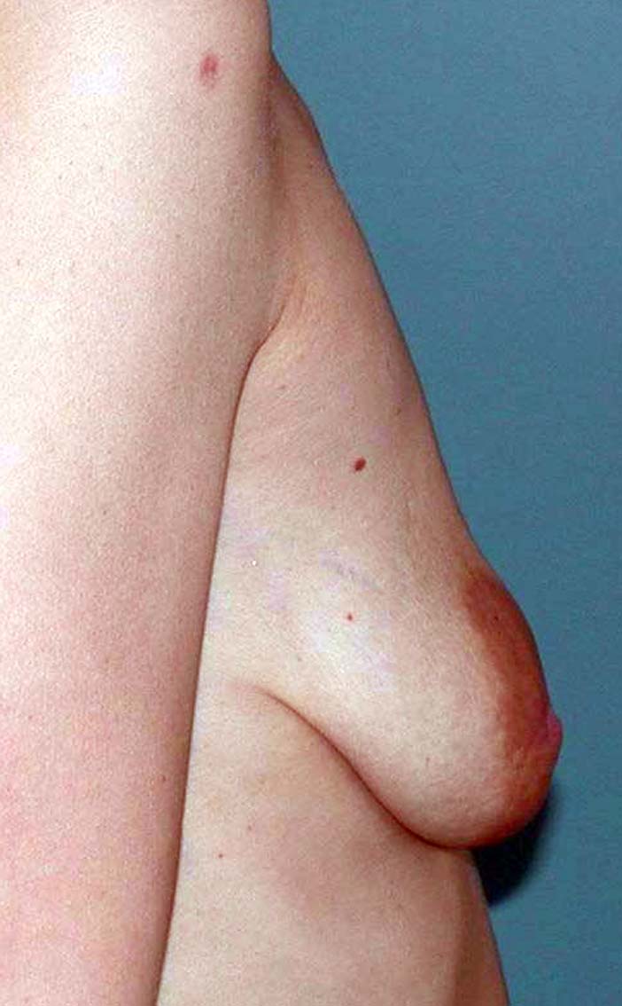 chirurgie-esthétique-correction-ptose-avec-implants10