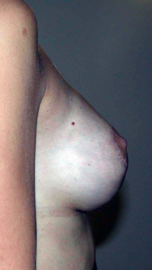 chirurgie-esthétique-correction-ptose-avec-implants11